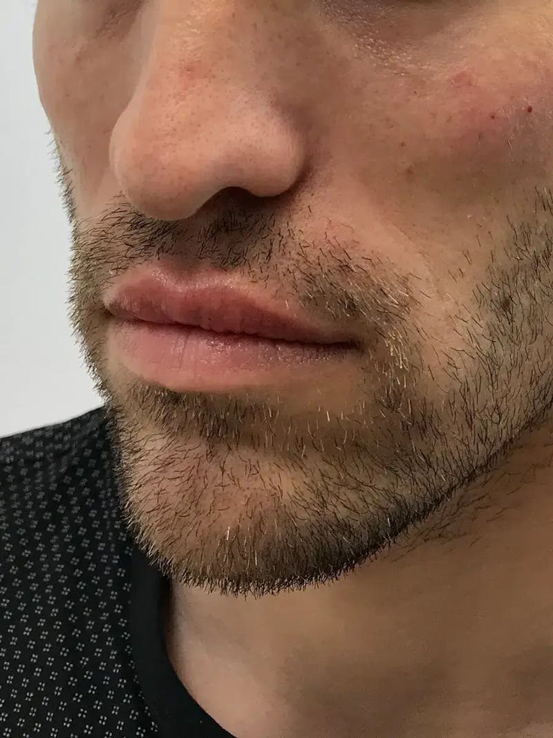 Lip Filler Before & After Gallery - Patient 863254 - Image 6