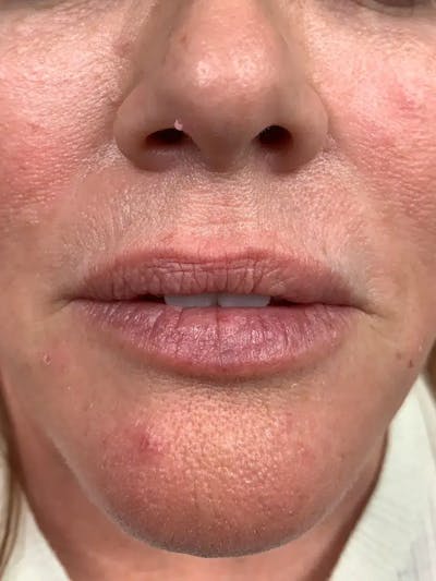 Lip Filler Before & After Gallery - Patient 445991 - Image 1