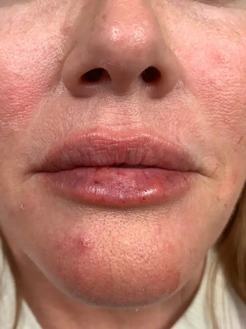 Lip Filler Before & After Gallery - Patient 309334 - Image 2