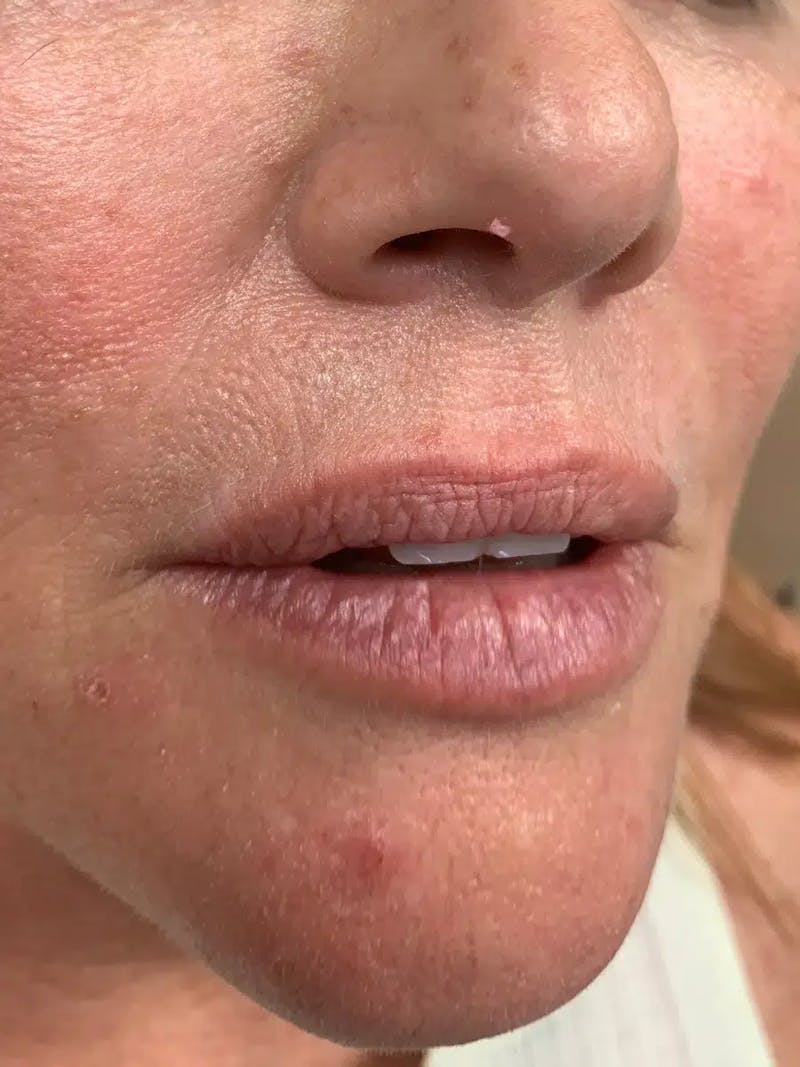 Lip Filler Before & After Gallery - Patient 309334 - Image 3
