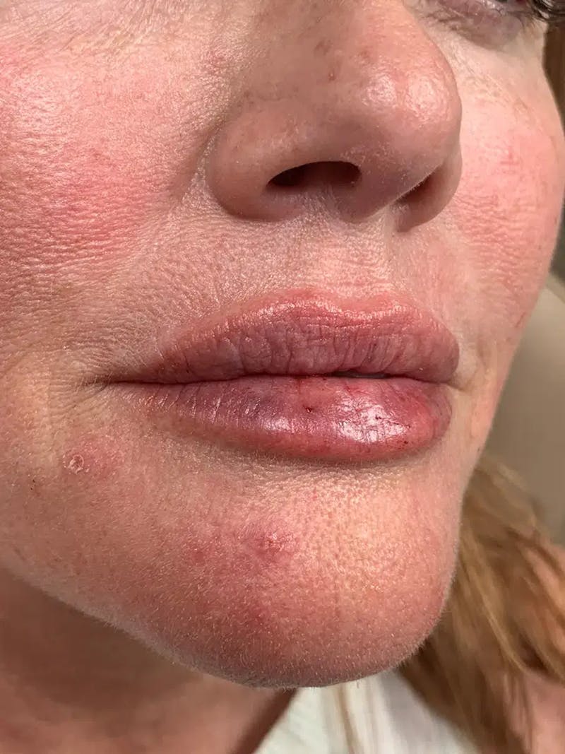 Lip Filler Before & After Gallery - Patient 309334 - Image 4