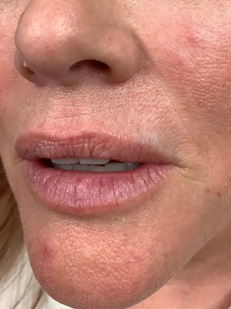 Lip Filler Before & After Gallery - Patient 309334 - Image 5