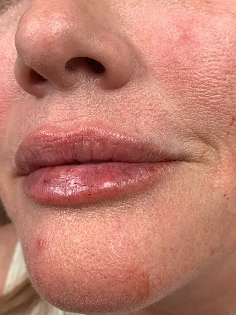 Lip Filler Before & After Gallery - Patient 309334 - Image 6
