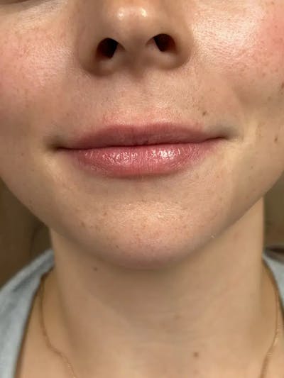 Lip Filler Before & After Gallery - Patient 256071 - Image 1