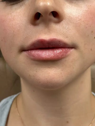 Lip Filler Before & After Gallery - Patient 256071 - Image 2