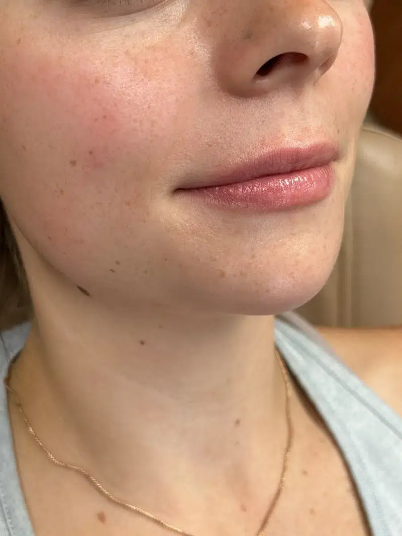 Lip Filler Before & After Gallery - Patient 414305 - Image 3