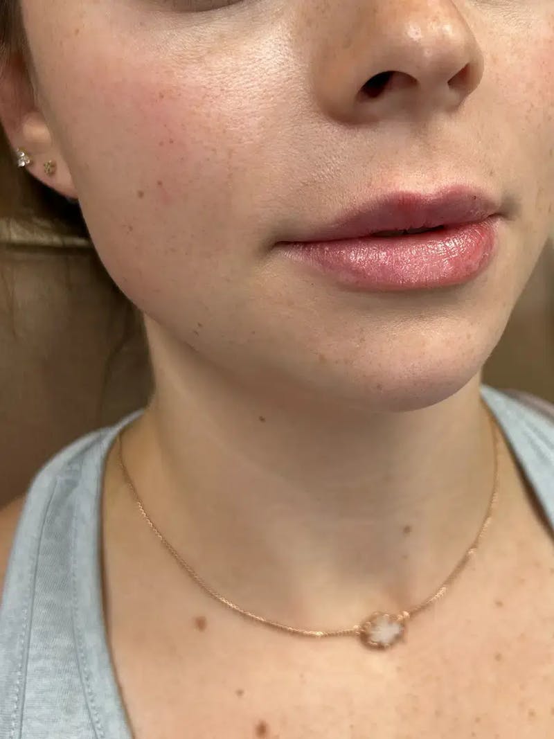 Lip Filler Before & After Gallery - Patient 414305 - Image 4