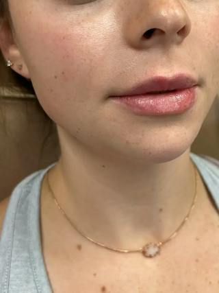 Lip Filler Before & After Gallery - Patient 256071 - Image 4