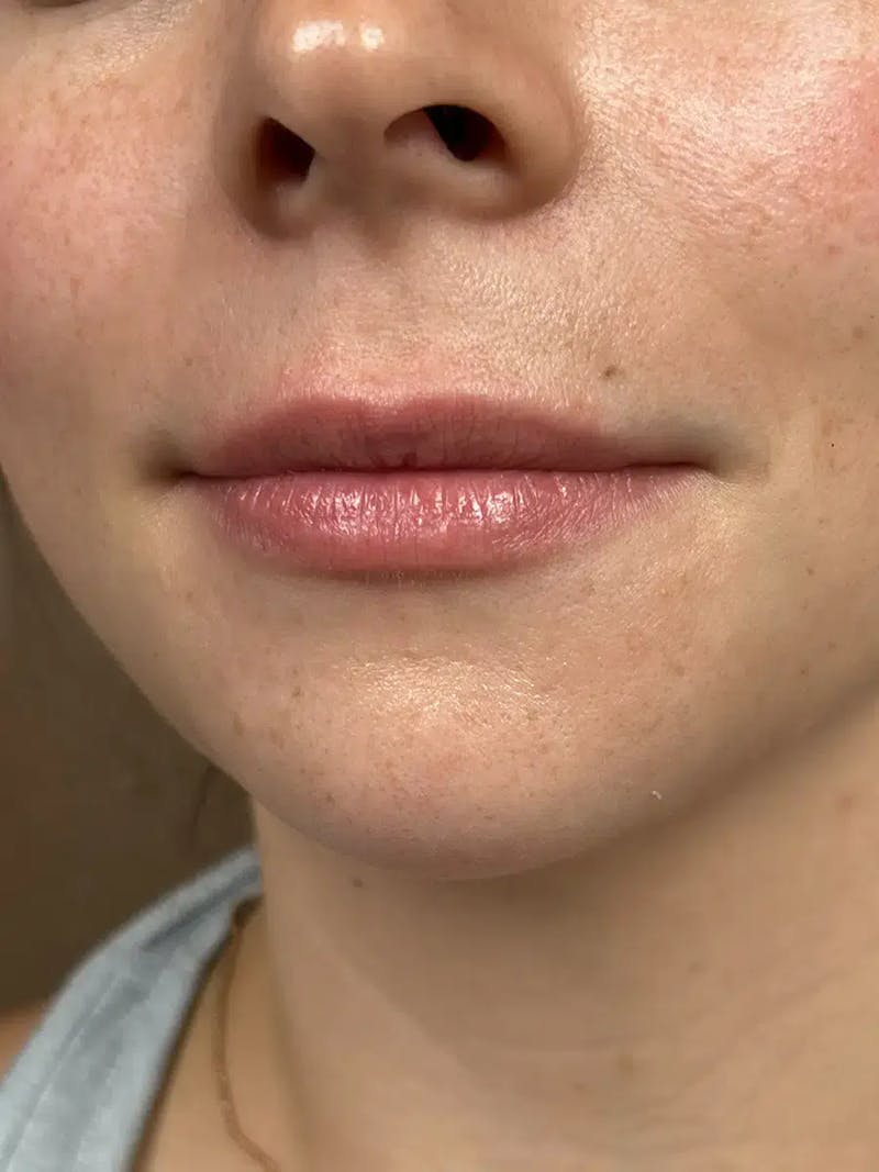 Lip Filler Before & After Gallery - Patient 414305 - Image 5