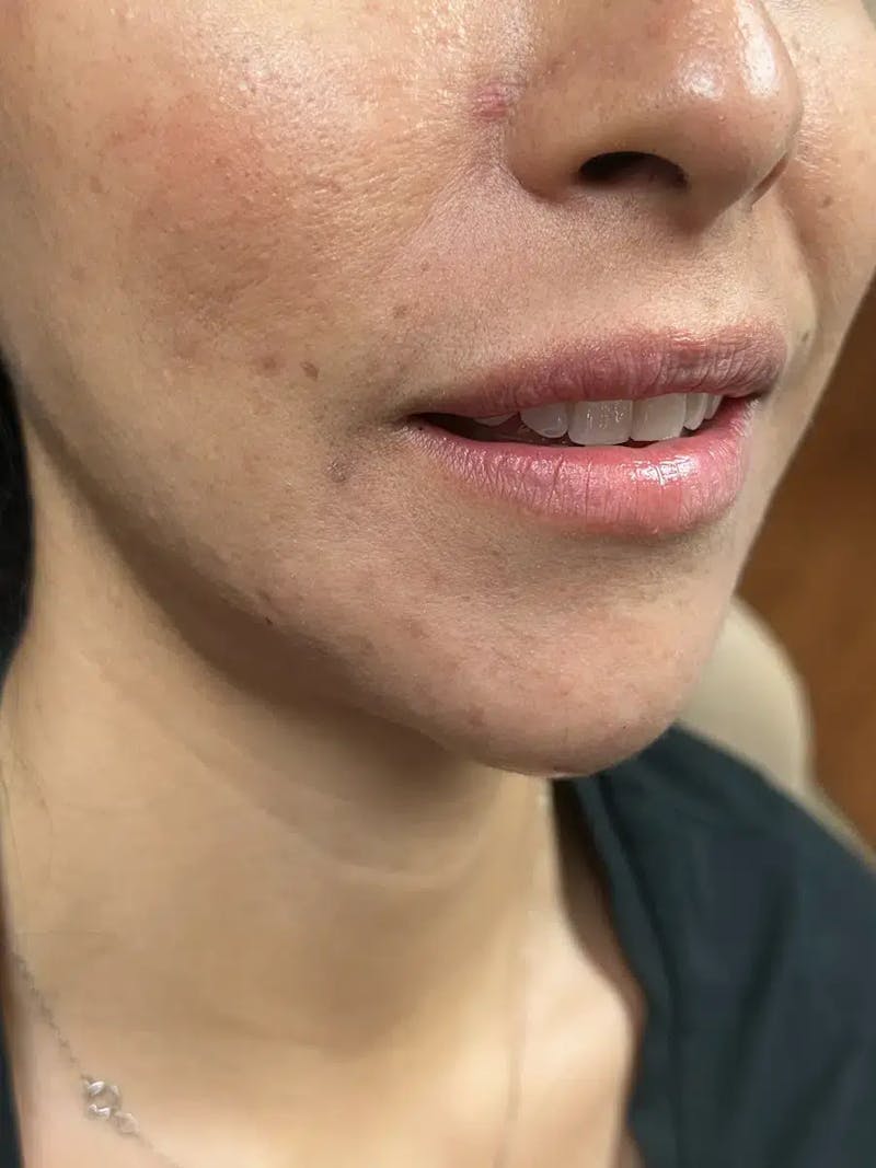 Lip Filler Before & After Gallery - Patient 369502 - Image 1