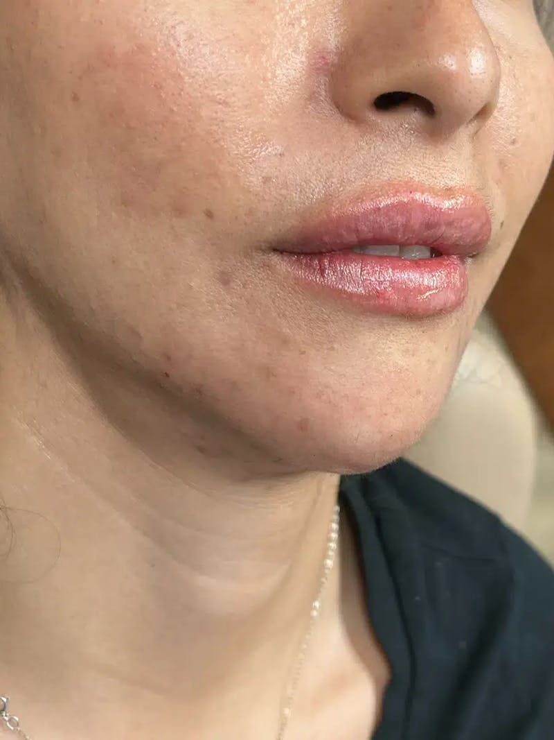 Lip Filler Before & After Gallery - Patient 369502 - Image 2