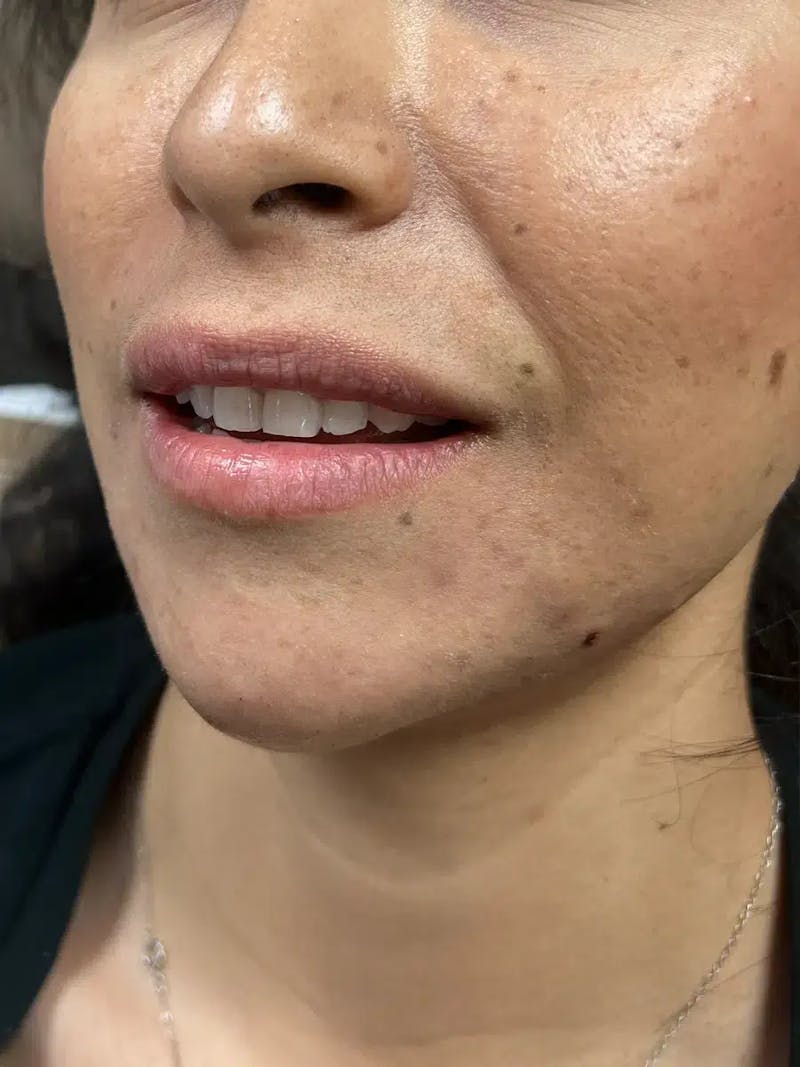 Lip Filler Before & After Gallery - Patient 369502 - Image 3