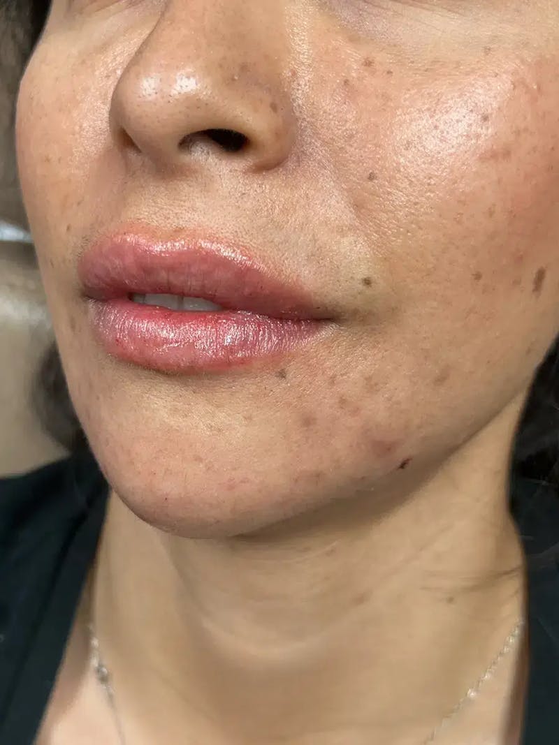 Lip Filler Before & After Gallery - Patient 369502 - Image 4