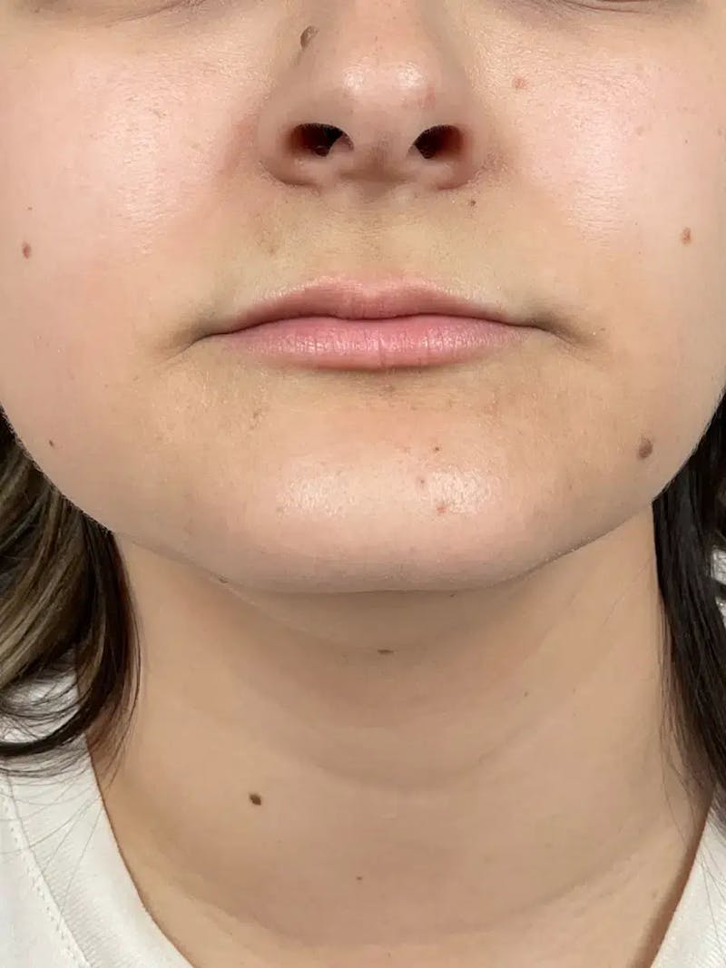 Lip Filler Before & After Gallery - Patient 383146 - Image 1