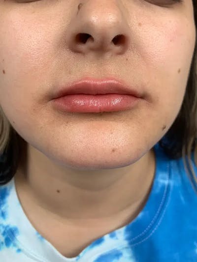 Lip Filler Before & After Gallery - Patient 178074 - Image 2
