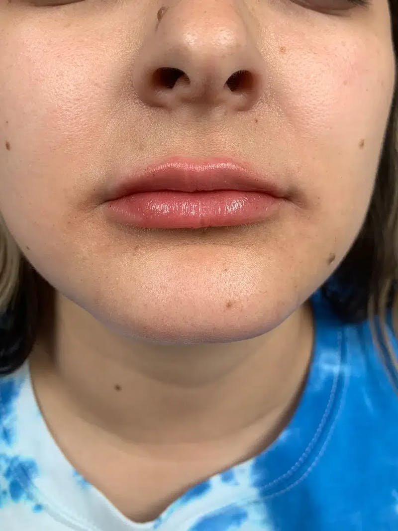Lip Filler Before & After Gallery - Patient 383146 - Image 2