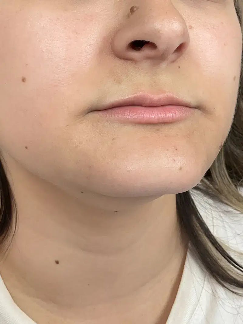 Lip Filler Before & After Gallery - Patient 383146 - Image 3