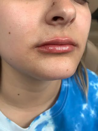 Lip Filler Before & After Gallery - Patient 383146 - Image 4