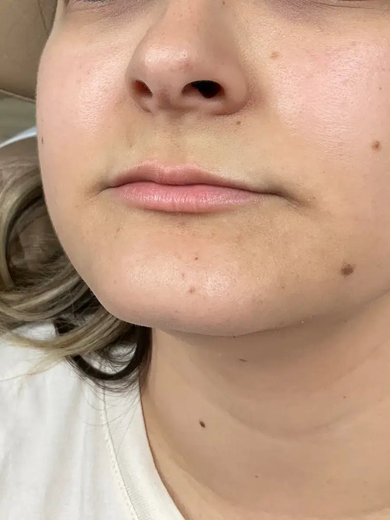 Lip Filler Before & After Gallery - Patient 383146 - Image 5