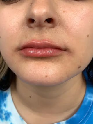 Lip Filler Before & After Gallery - Patient 383146 - Image 6