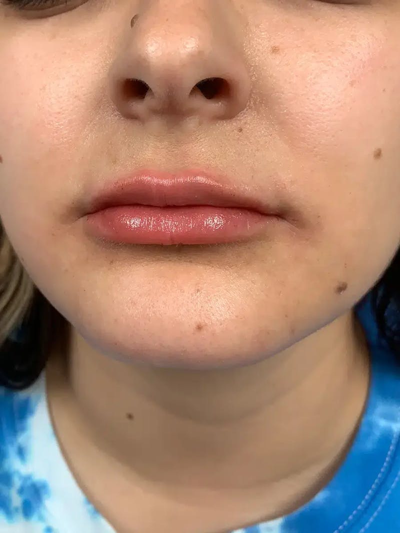Lip Filler Before & After Gallery - Patient 383146 - Image 6