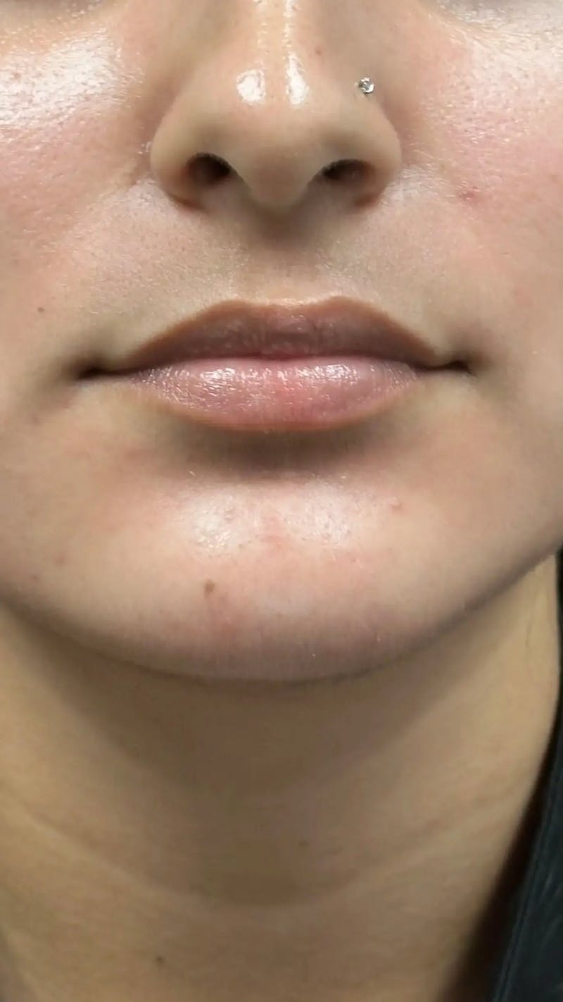 Lip Filler Before & After Gallery - Patient 399757 - Image 1