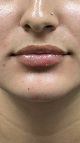 Lip Filler Before & After Gallery - Patient 399757 - Image 2