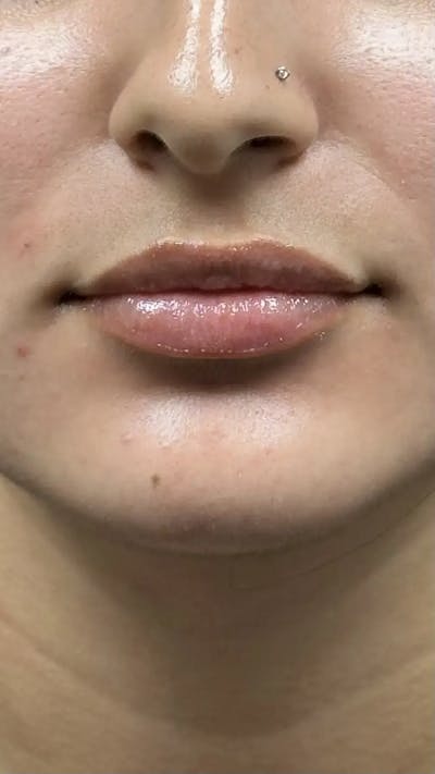 Lip Filler Before & After Gallery - Patient 531903 - Image 2