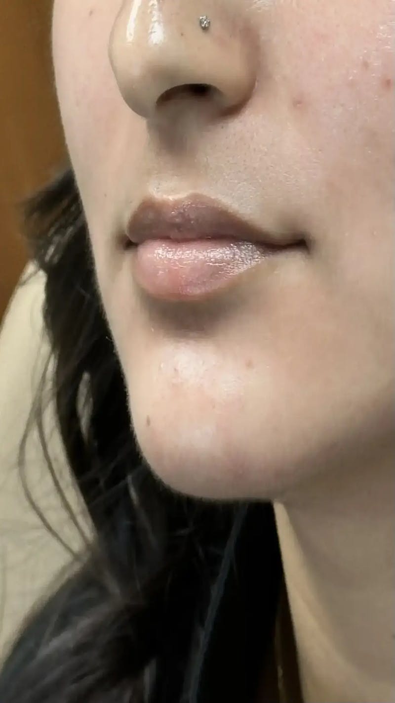 Lip Filler Before & After Gallery - Patient 399757 - Image 3