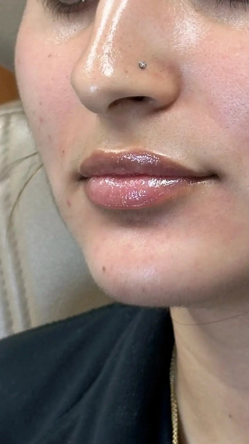 Lip Filler Before & After Gallery - Patient 399757 - Image 4
