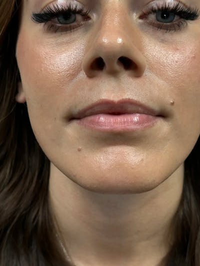 Lip Filler Before & After Gallery - Patient 281360 - Image 1