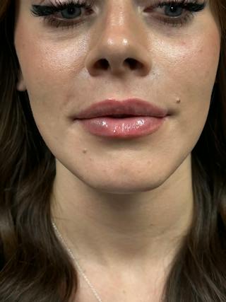 Lip Filler Before & After Gallery - Patient 731811 - Image 2