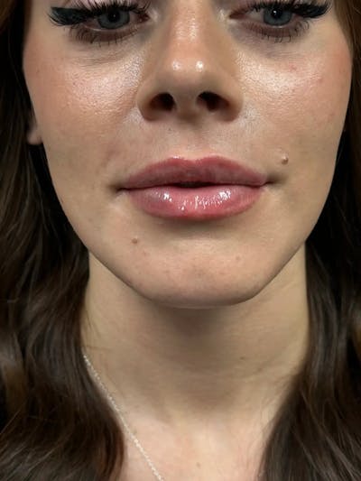 Lip Filler Before & After Gallery - Patient 281360 - Image 2