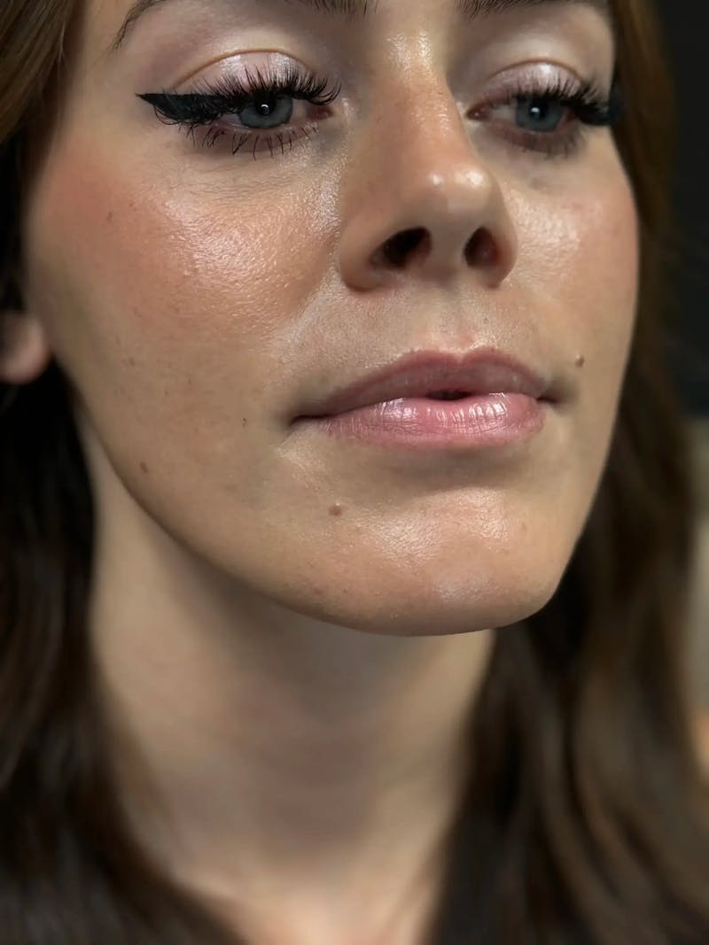 Lip Filler Before & After Gallery - Patient 731811 - Image 3