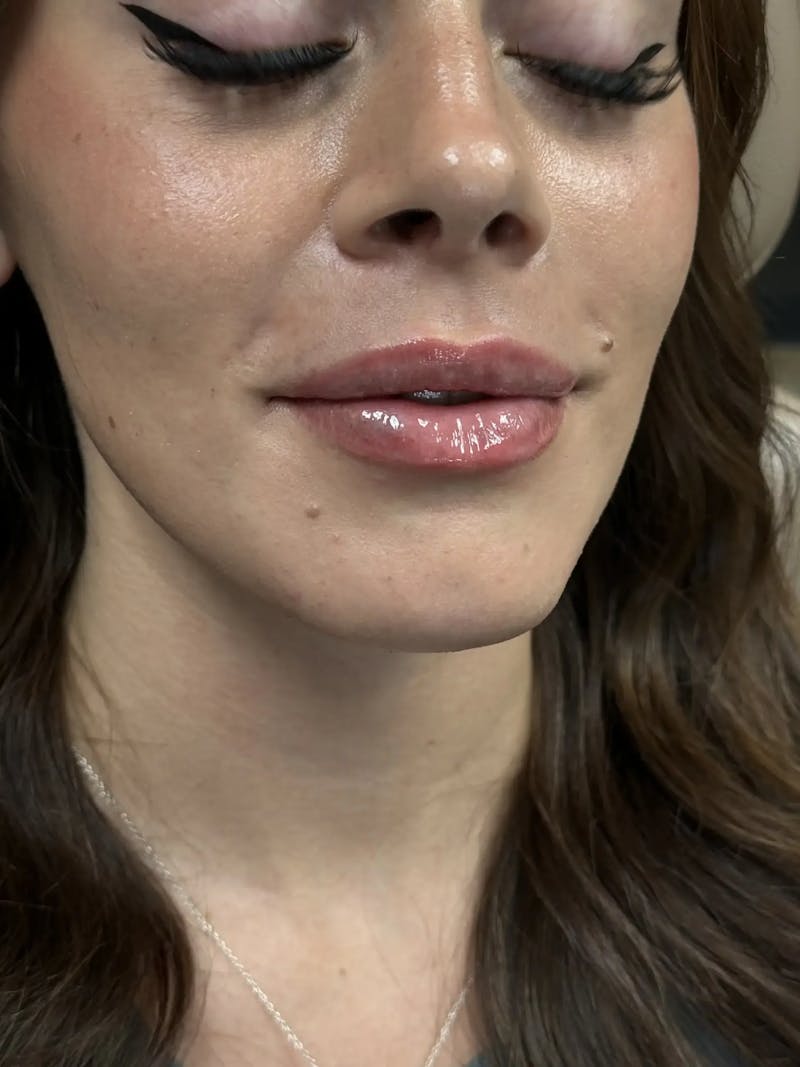Lip Filler Before & After Gallery - Patient 731811 - Image 4