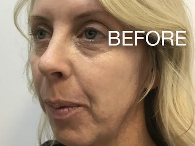 Jawline Contouring Before & After Gallery - Patient 234854 - Image 1