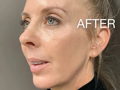 Jawline Contouring Before & After Gallery - Patient 234854 - Image 2