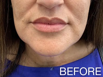 Kybella Before & After Gallery - Patient 128892 - Image 1