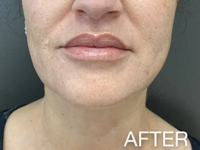Kybella Before & After Gallery - Patient 128892 - Image 2