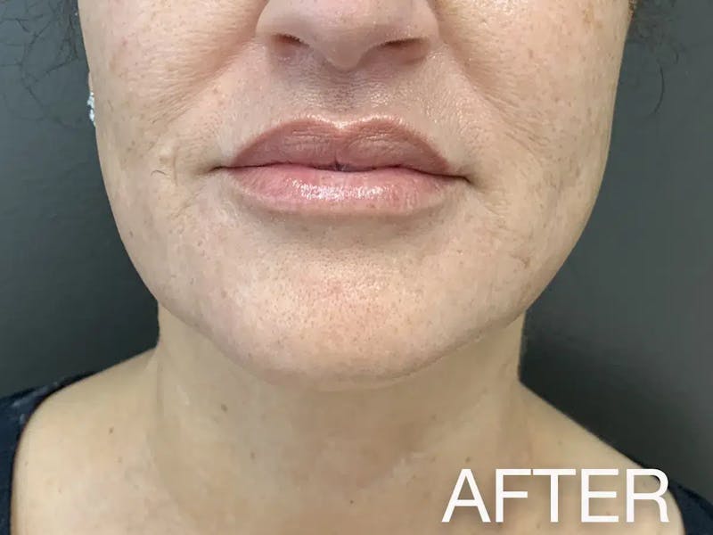 Kybella Before & After Gallery - Patient 128892 - Image 2