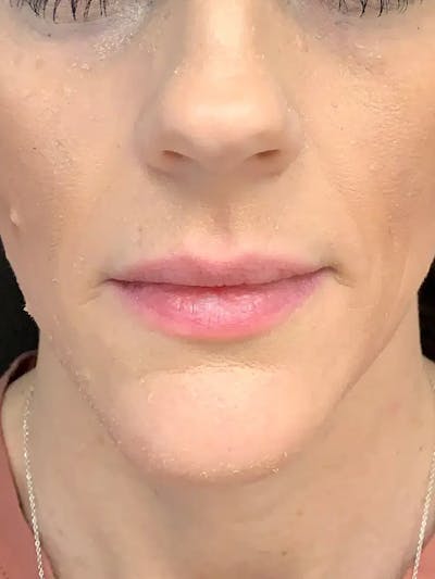 Sculptra Before & After Gallery - Patient 374467 - Image 1