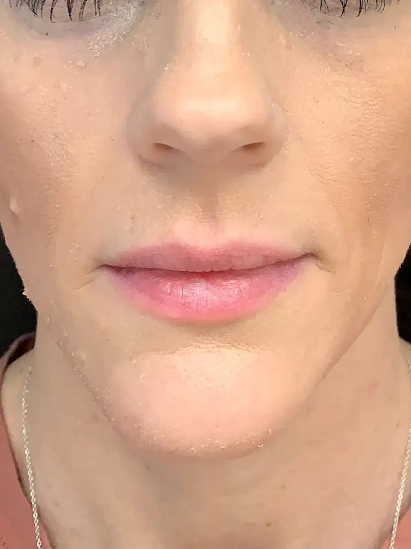 Sculptra Before & After Gallery - Patient 374467 - Image 1