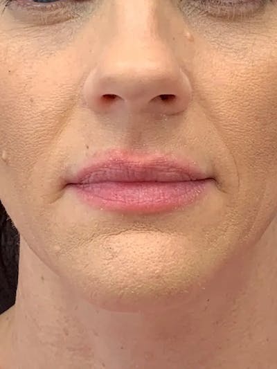 Sculptra Before & After Gallery - Patient 374467 - Image 2