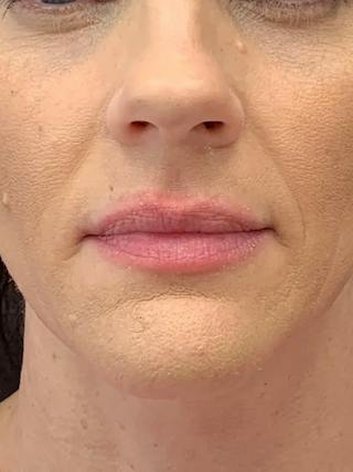 Biostimulators Before & After Gallery - Patient 374467 - Image 2