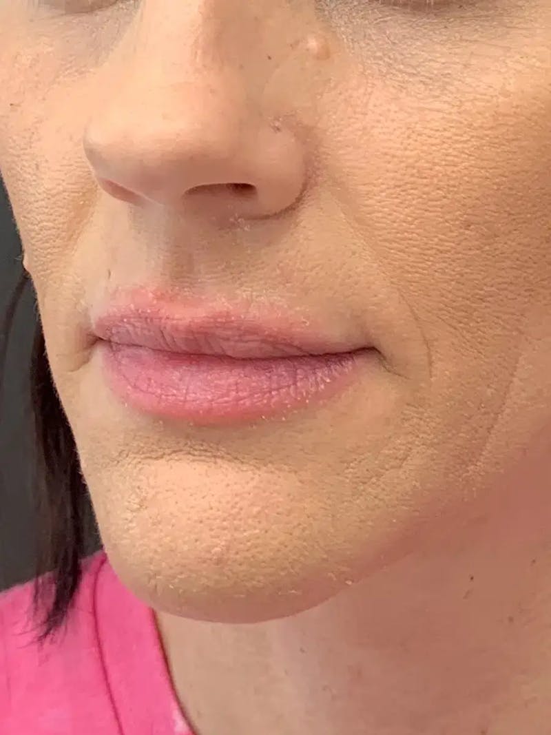 Sculptra Before & After Gallery - Patient 374467 - Image 4