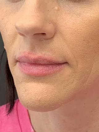 Biostimulators Before & After Gallery - Patient 374467 - Image 4