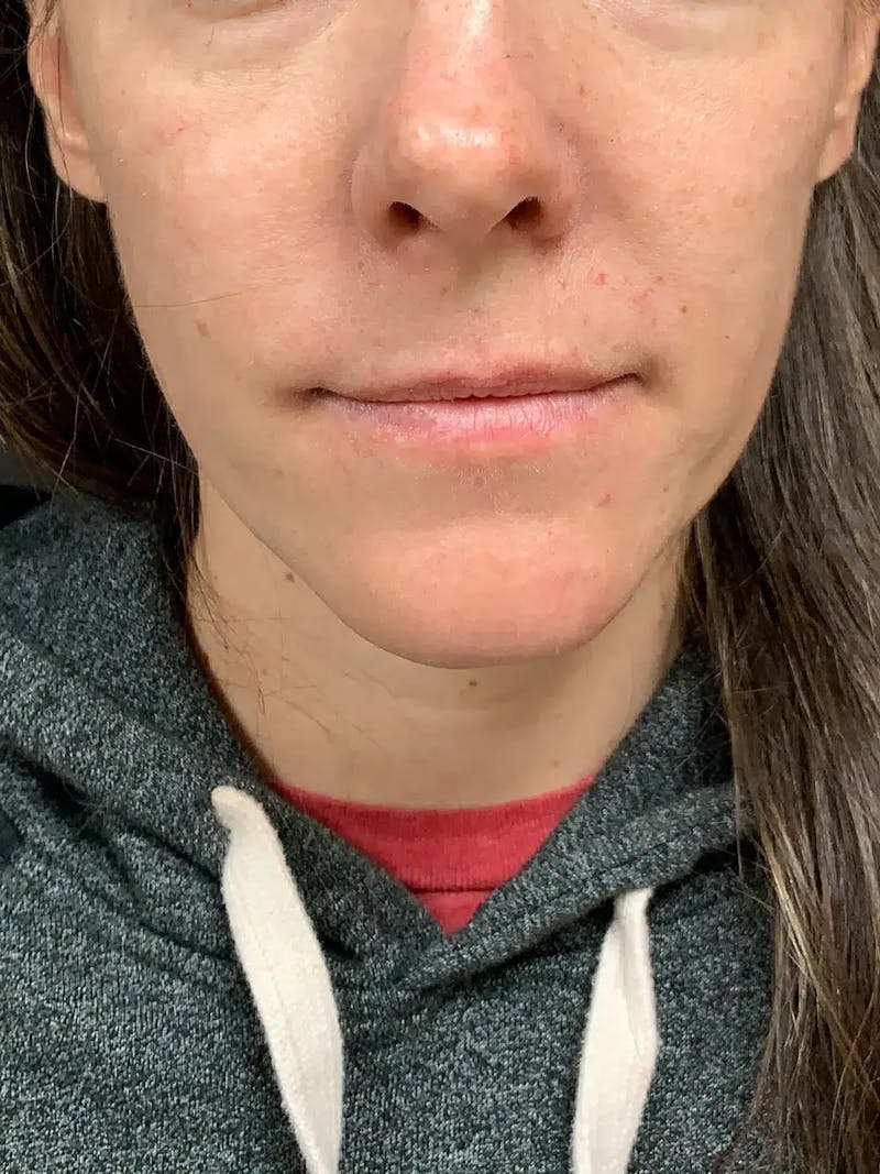 Sculptra Before & After Gallery - Patient 218005 - Image 1