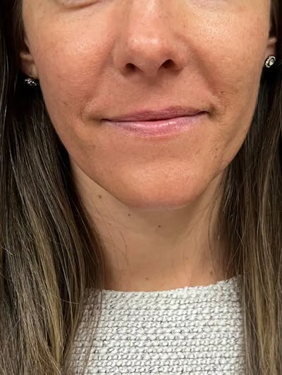 Sculptra Before & After Gallery - Patient 218005 - Image 2