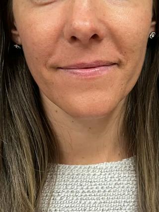 Biostimulators Before & After Gallery - Patient 218005 - Image 2