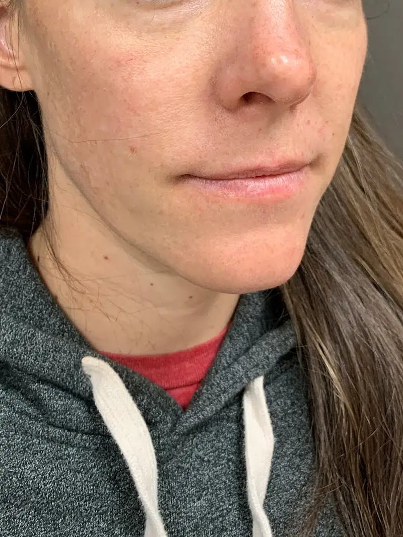 Sculptra Before & After Gallery - Patient 218005 - Image 3